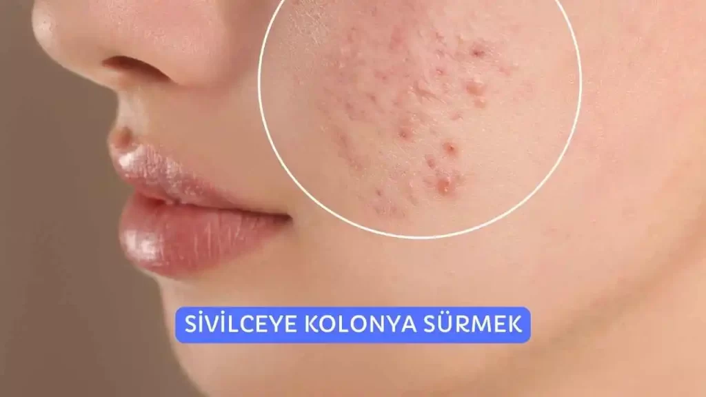 Sivilceye Kolonya Sürmek İyi Gelir Mi? Güncel ve Doğru Bilgi