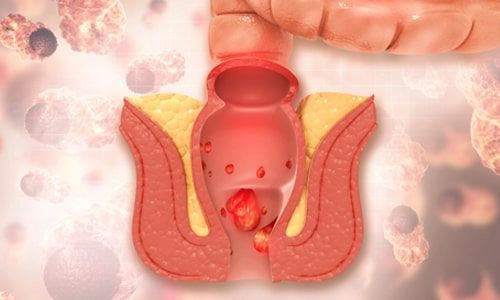 hemoroid basur